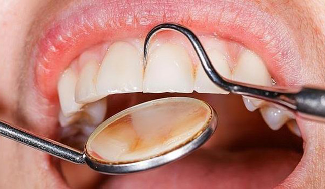 70 por ciento de la población padece problemas en los dientes
