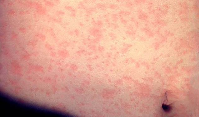 Casos de sarampión, consecuencia de movimiento antivacunas, dice especialista