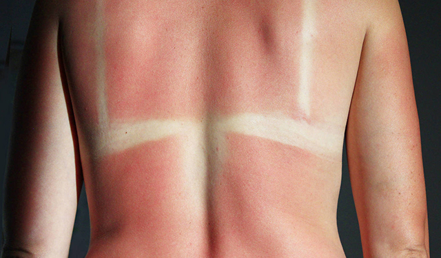 Exposición prolongada al sol causa daño irreversible a la piel IMSS
