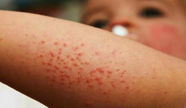 Secretaría de Salud emite medidas preventivas de viaje por sarampión